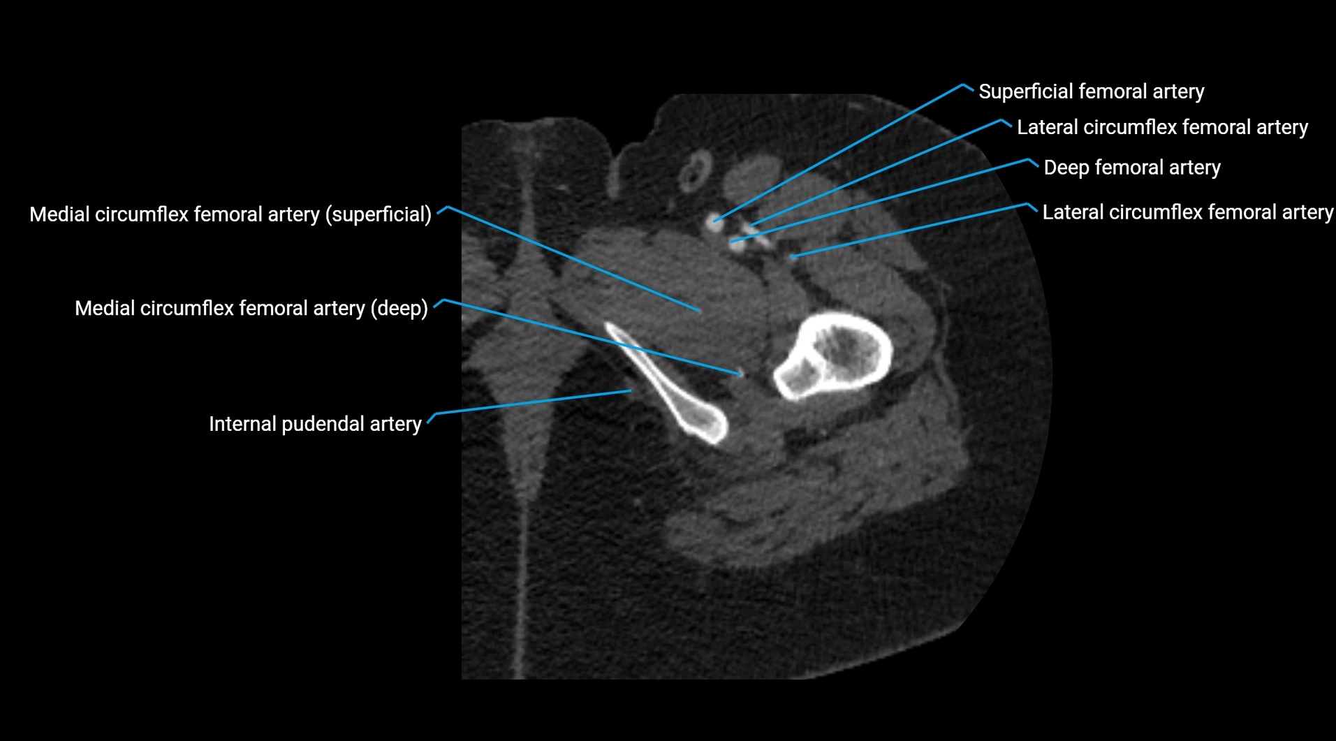 CTA lower limb cross sectional anatomy labelled image _74.webp